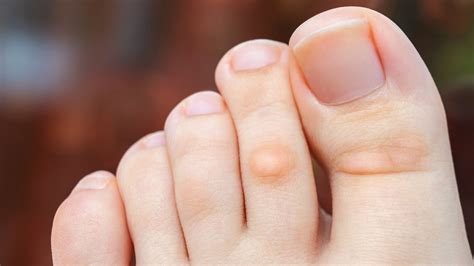 Corns Vs Calluses How To Soothe Rough Soles Goodrx