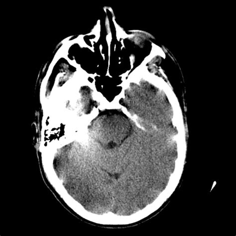 A Head Ct Without Contrast Demonstrating Subtle Ill Defined Regions Of
