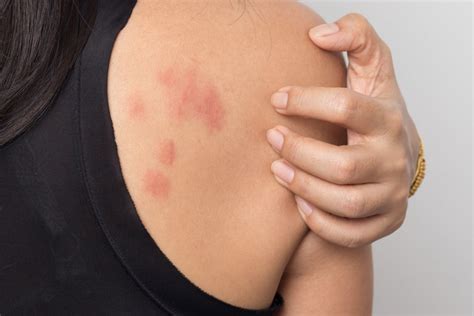 Stress Rash What It Is How To Treat And Prevent Pharmacists Org