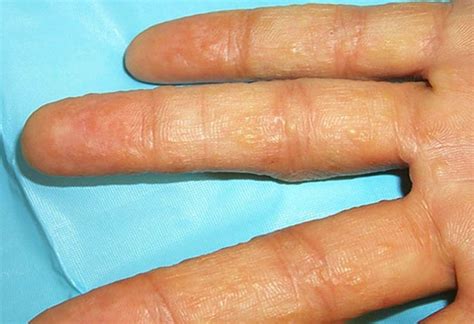 Dyshidrotic Eczema Pictures Contagious Treatment Causes