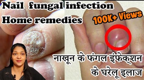 Paronychia Treatment Home Remedies In Hindi Finger Infection Home