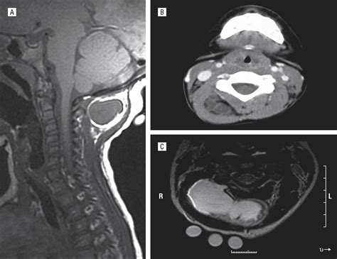 Intramuscular Myxoma Presenting As A Rare Posterior Neck Mass In A