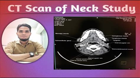 Ct Scan Of Neck Study Youtube