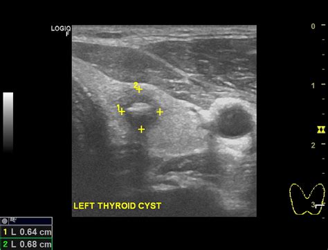 Thyroid Cysts Dr Jeeve Ent Specialist