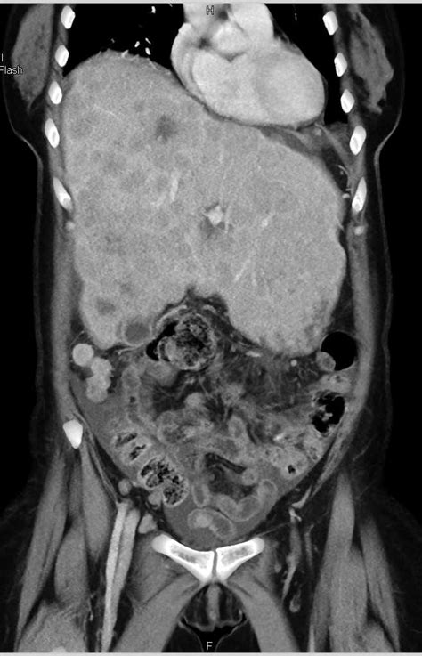 Metastatic Colon Cancer To Liver With Carcinomatosis Liver Case