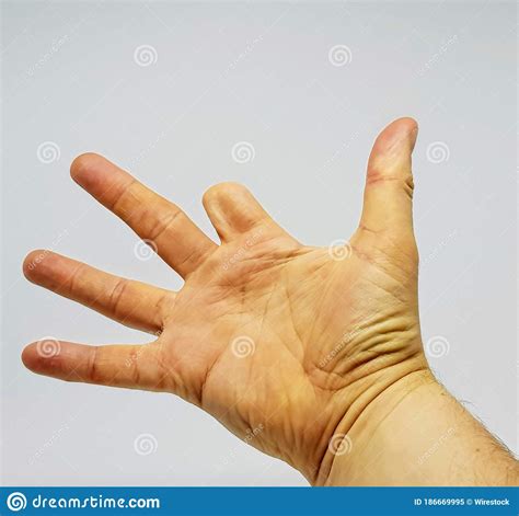 Hand Of A Person With A Part Of The Index Finger Missing Due To A Prior ...
