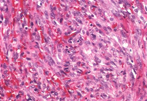 Kaposi Sarcoma Atlas Of Pulmonary Pathology Flickr