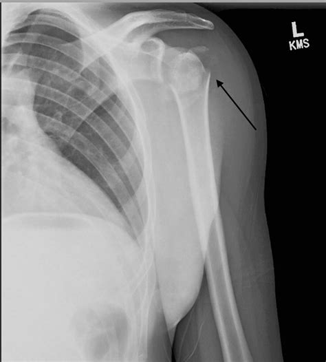 Cureus An Irreducible Posterior Fracture Dislocation Of The Shoulder