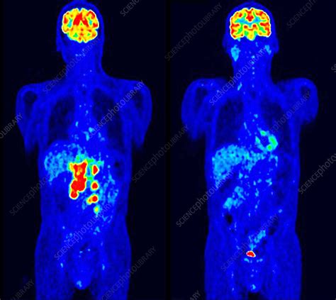 Diffuse Large B Cell Lymphoma Pet Scans Stock Image C0549036