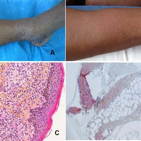Case Reports Of Erythema Nodosum Associated With Syphilis Download