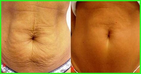 Cool How To Tighten Skin On Stomach Without Surgery 2022