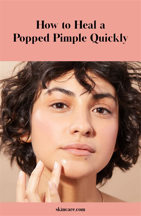 How To Heal A Popped Pimple Quickly And Safely In 5 Easy Steps