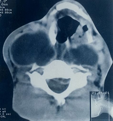 Computed Tomographic Ct Scan Of The Neck Showing Large Hypodense