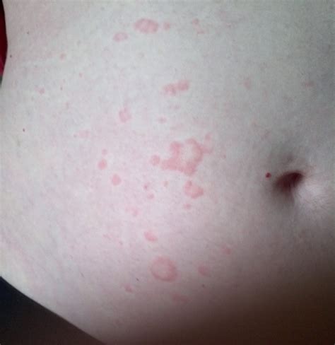 No, vinegar can actually help get rid of the skin rash. Kirkland Ultra Free And Clear Rash - Kirkland Ultra Free ...