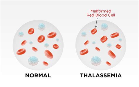 Thalassemia Cells