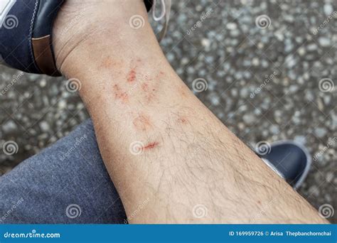 Skin Disease Winter Healthcare Dry Cracking Skin And Rash Red Of Leg