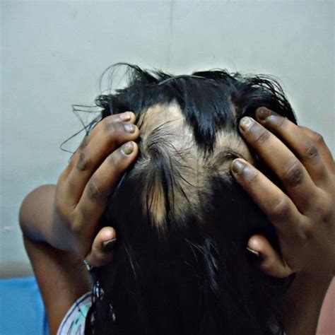 Clinical Photograph Showing Dystrophy Of Finger Nails With Alopecia