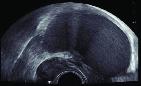 A Nodular Solid Lesion In The Ovarian Fossa Visualized In Transrectal