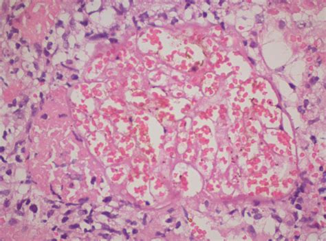 Kidney Cortex Necrosis Renal Cortical Necrosis