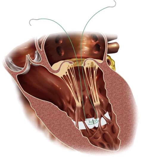 Minimally Invasive Papillary Muscle Sling Placement During Mitral Valve