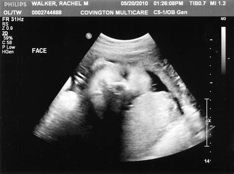 A Life Of Surprises 34 Week Ultrasound