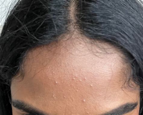Unknown Bumps On My Forehead Skincareaddicts
