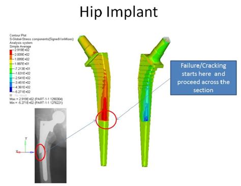 Deps Meshworks Extend Life Of Hip Implants The Nfa Post