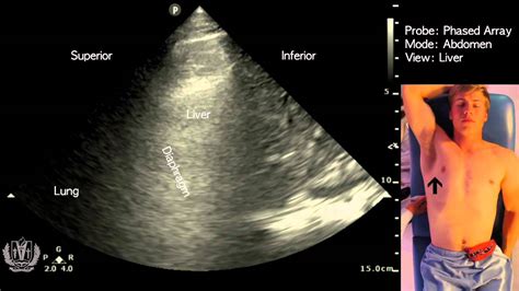 Abdominal Ultrasound Basics Of Evaluating The Liver YouTube