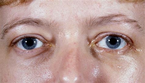 आंखों में सूजन और लाली क्यों होते हैं जानें कारण और इलाज News Aroma