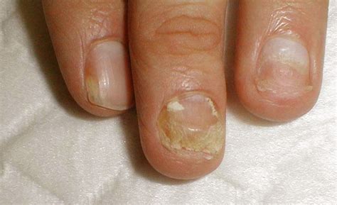 White Spots On The Nails No Its Not The Lack Of Calcium
