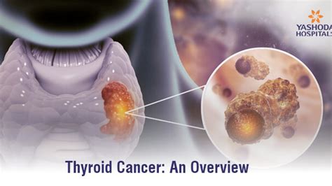 Stage 4 Thyroid Cancer Symptoms Doctorvisit