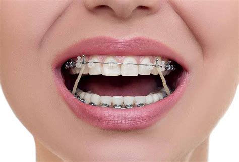 What To Expect When Getting Orthodontic Braces Inspirational Bodies