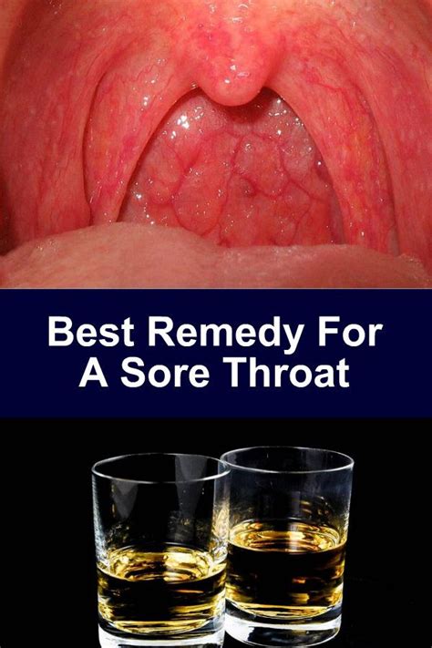 Best Remedy For A Sore Throat Having A Raw Swollen Throat Is Painful