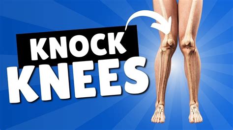 Physical Education Knock Knees Corrective Exercises And Treatment For