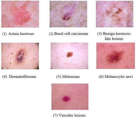 Types Of Skin Lesions Skin Lesions Symptoms Causes And Treatment