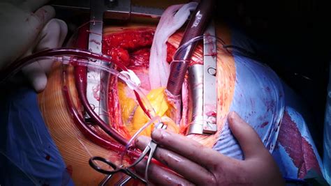 The procedure is a repair of a hole in the heart. Closeup of Open Heart Surgery. Stock Footage Video (100% ...