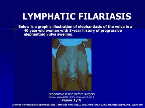 Ppt Lymphatic Filariasis A Major Public Health Challenge In The 21st