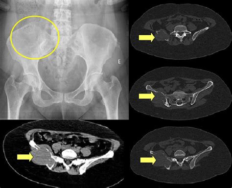 Lesions On Pelvic Bones Spectrum And Radiologic Findings Semantic