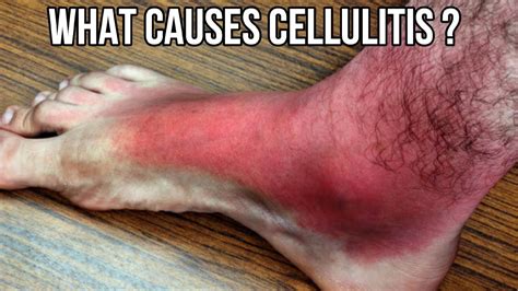 Cellulitis What Causes Cellulitis Prevention And Treatment Youtube