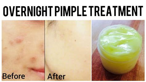 how to remove pimples overnight homemade pimple cream acne scar treatment youtube