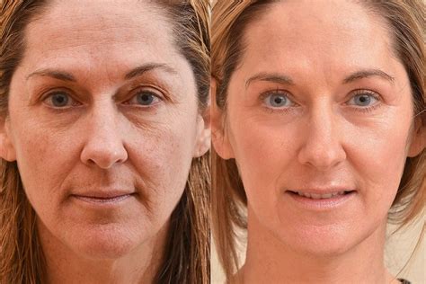 Causes Of Wrinkles And How Skin Laser Rejuvenation Helps Laser Skin