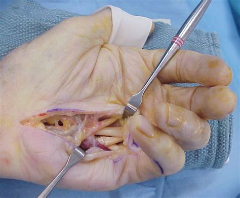 Reconstruction: Small finger flexor tendon rupture within the carpal tunnel