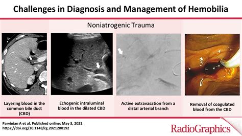 Challenges In Diagnosis And Management Of Hemobilia Radiographics
