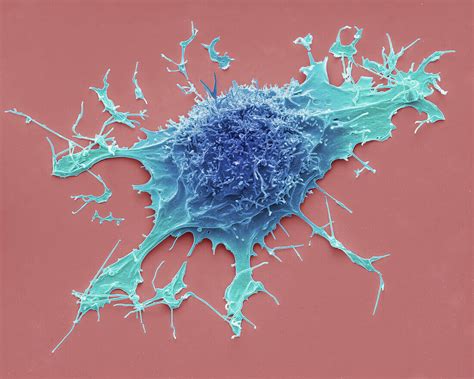 Lymphoma Cancer Cell Sem Bild Kaufen 13687056 Science Photo Library