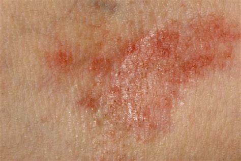 Side Effects Of Vitamin B Hives Rash And Heat Livestrongcom