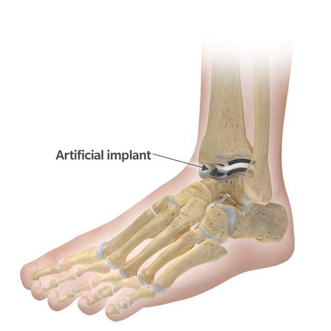 What To Expect During Total Ankle Replacement Surgery