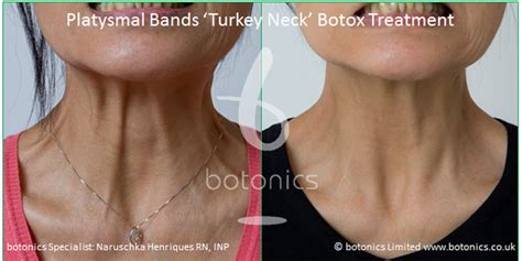 Platysmal Bands Turkey Neck Treatment With Botox Botonics