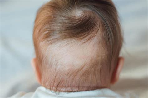 Baby Hair Loss A Guide For New Parents Littleonemag