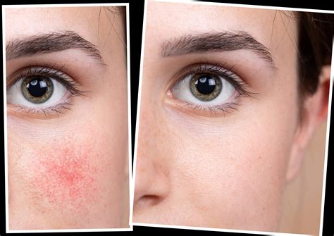 Reducing Rosacea Treatments With Lasers Balshi Dermatology