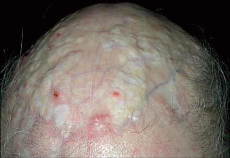 Diffuse Dystrophic Calcinosis Cutis Of The Scalp In A Patient With
